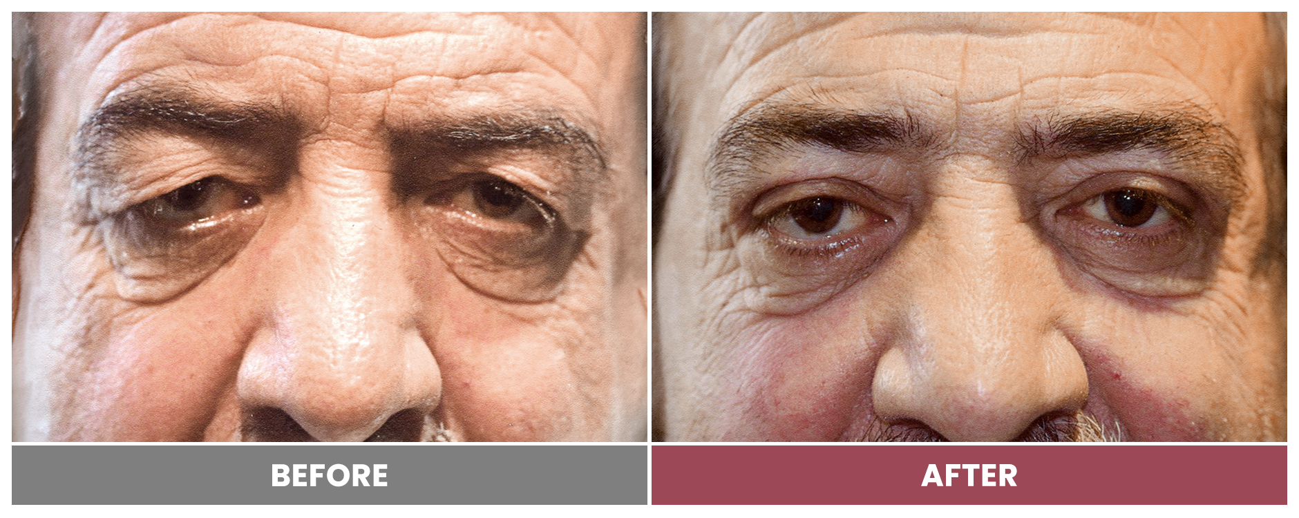 Upper Blepharoplasty - Case 104